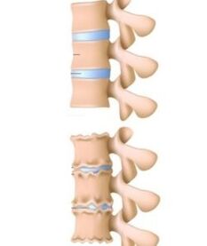 Las causas de la osteocondrosis