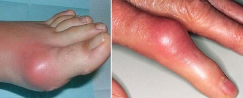 aparición de articulaciones con artritis