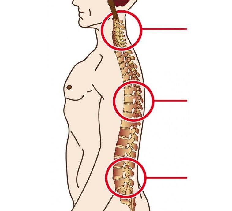 Localización de osteocondrosis cervical, torácica y lumbar.