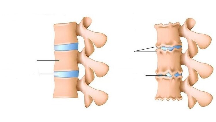 columna vertebral sana y columna afectada por osteocondrosis