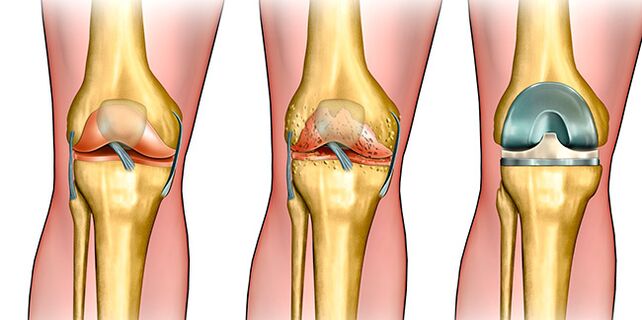 En la tercera etapa de la artrosis, se requiere reemplazo de rodilla.