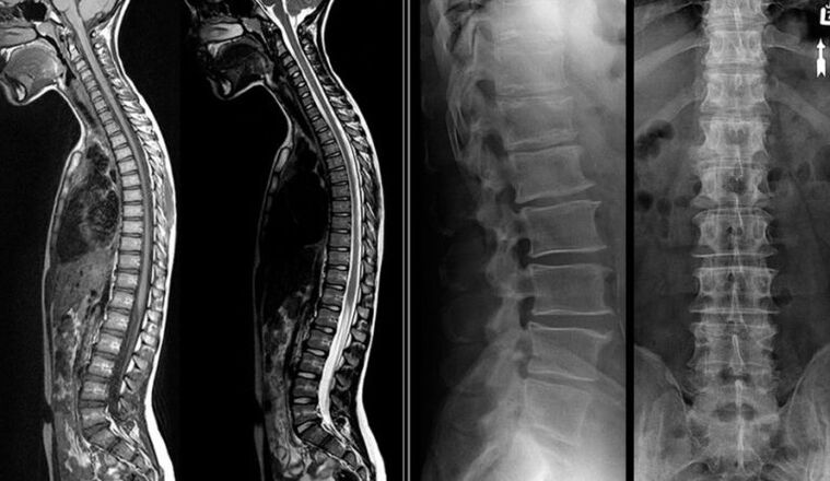 Imágenes de rayos X y resonancia magnética para la osteocondrosis