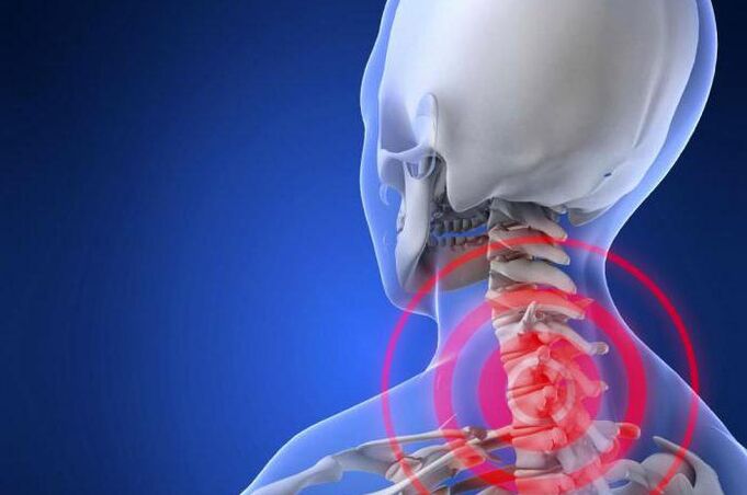 Dolor punzante en el cuello un síntoma temprano de osteocondrosis cervical