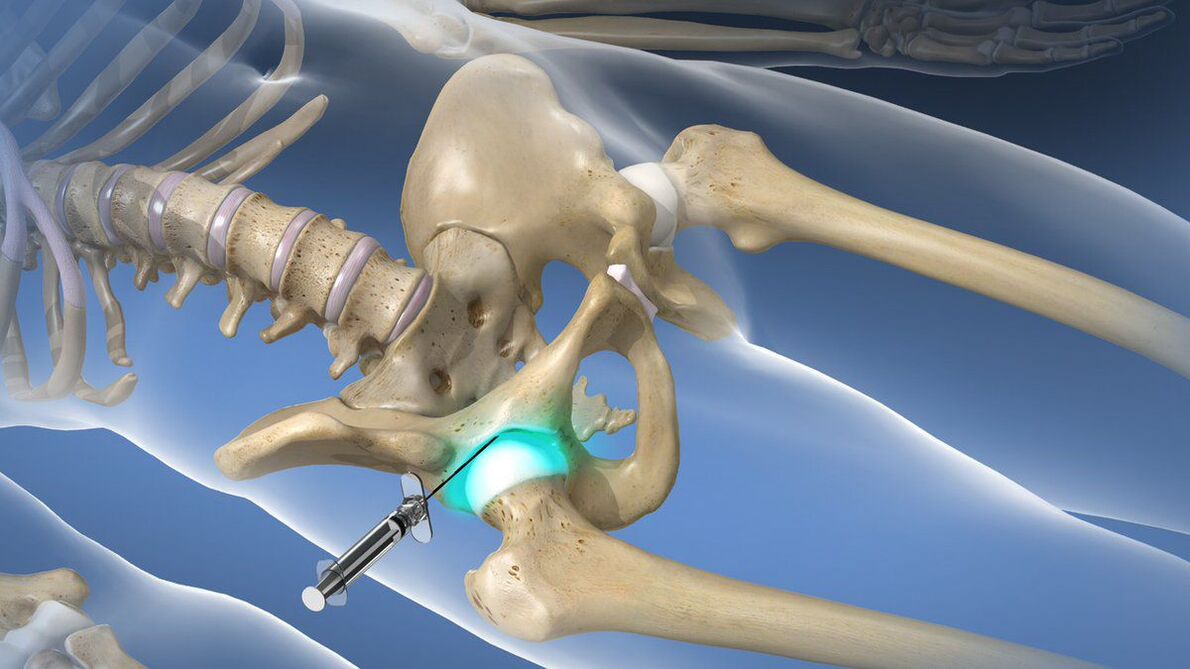 Bloqueo intraarticular para eliminar el dolor agudo en la coxartrosis