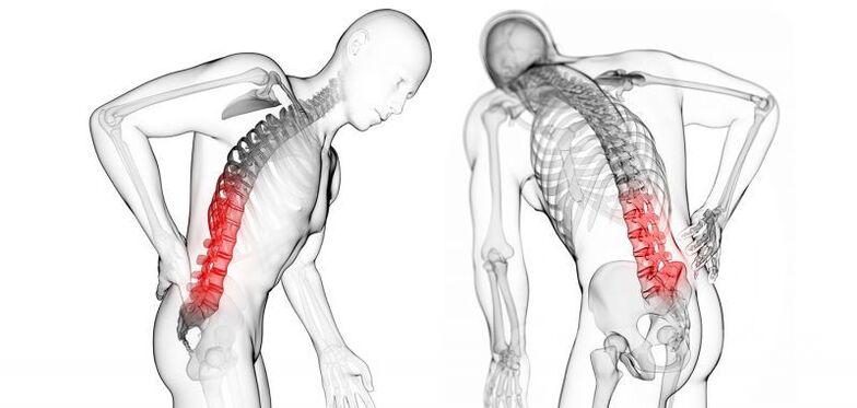 complicaciones con la osteocondrosis cervical